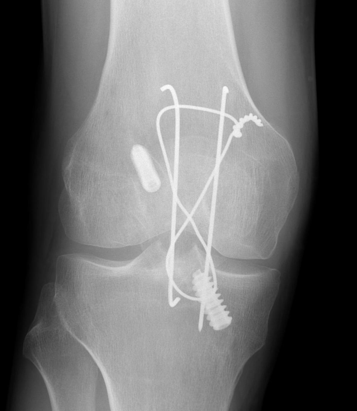 ACL BPTB Patella ORIF AP